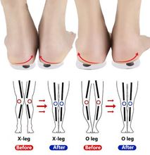 Orthopedic Insoles For Correcting O/X Type Leg Silicone Magnetic Shoe Cushions Knock Knee/Bow Legs